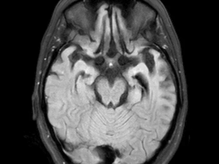 Brain MRI Scan