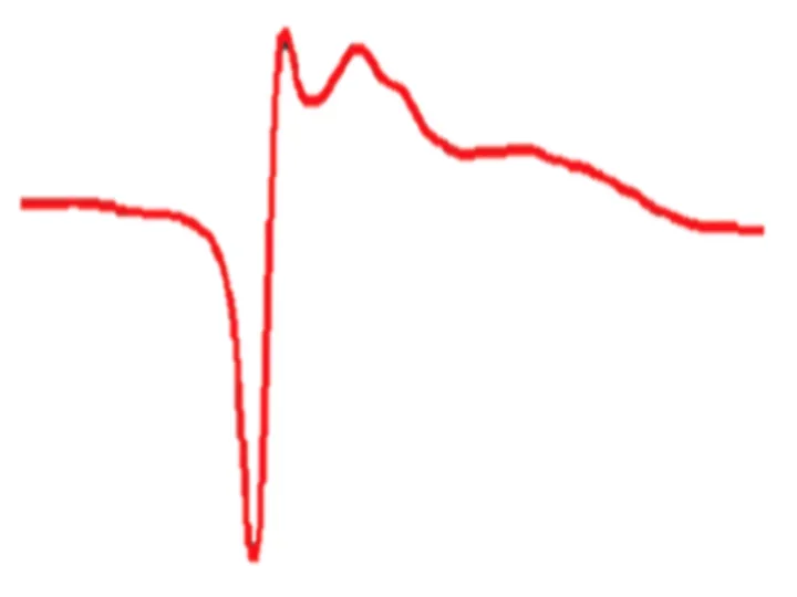 Epileptic spike