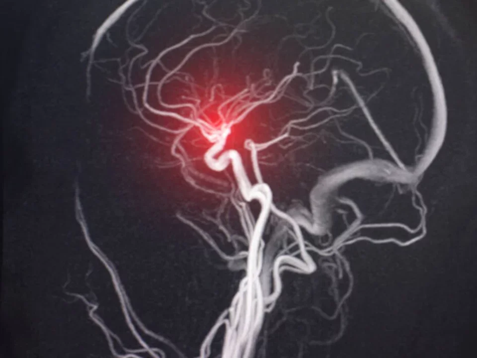 Brain MRI with blood vessel